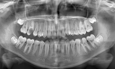 Diş Tedavisinde Panoramik Röntgenin Rolü